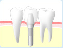 インプラント