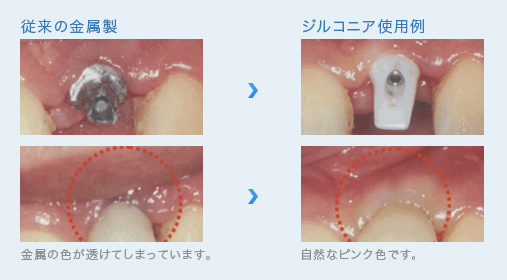 ジルコニア治療例