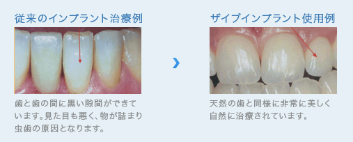 ザイブインプラント治療例