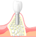 インプラント