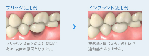 インプラントとブリッジの比較